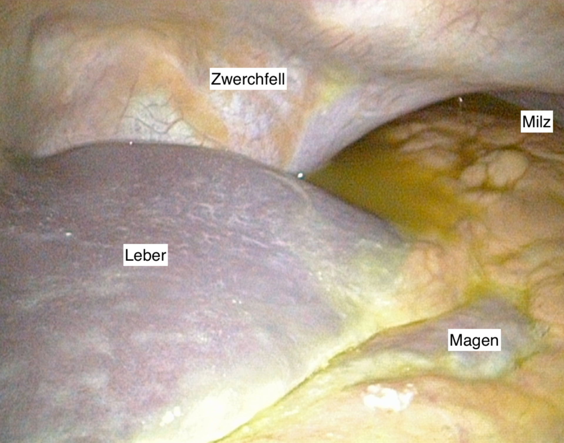 Peritonitis bei Magenperforation(Ulcus duodeni)