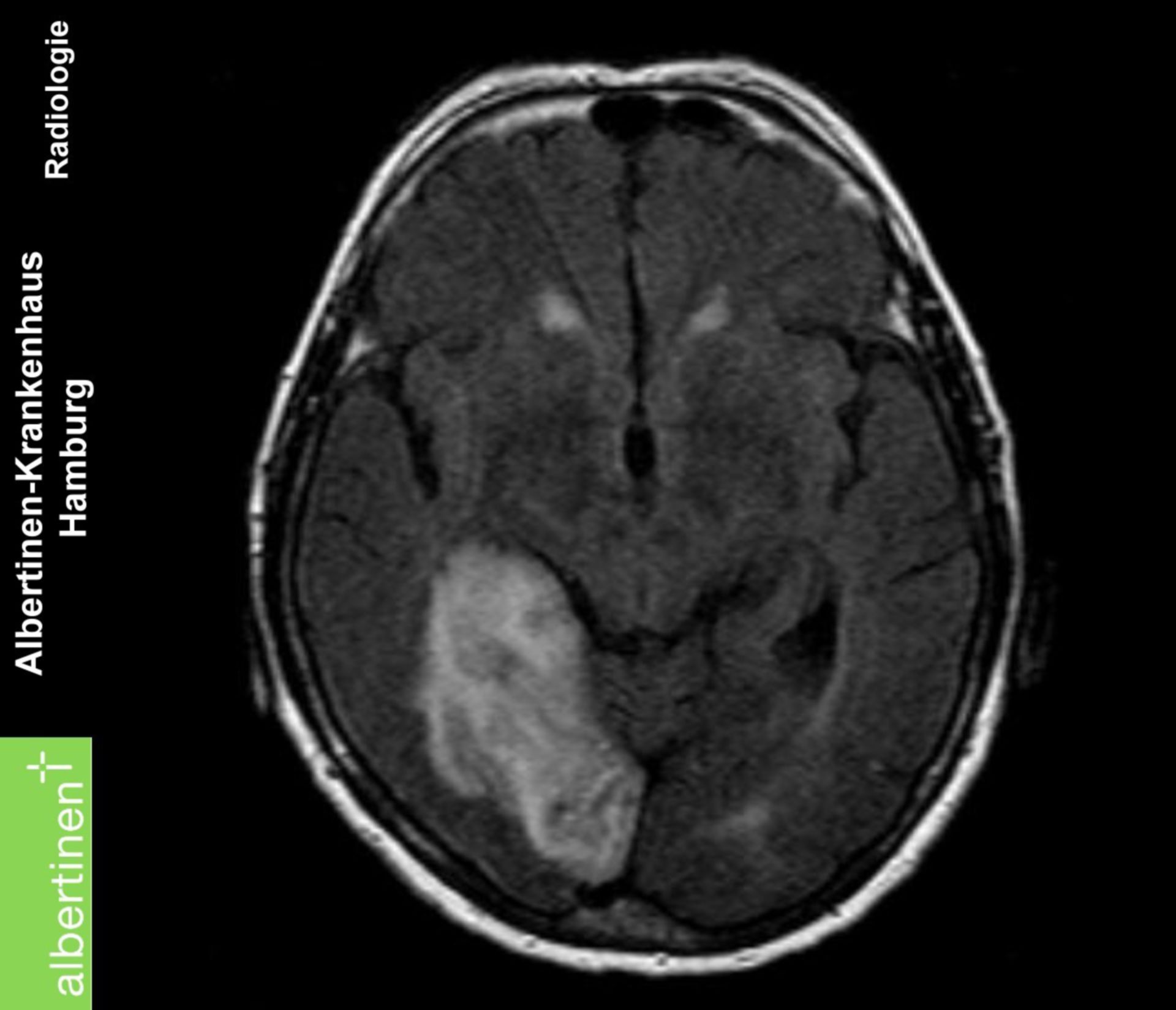 Tomografia a risonanza magnetica infarto cerebellare