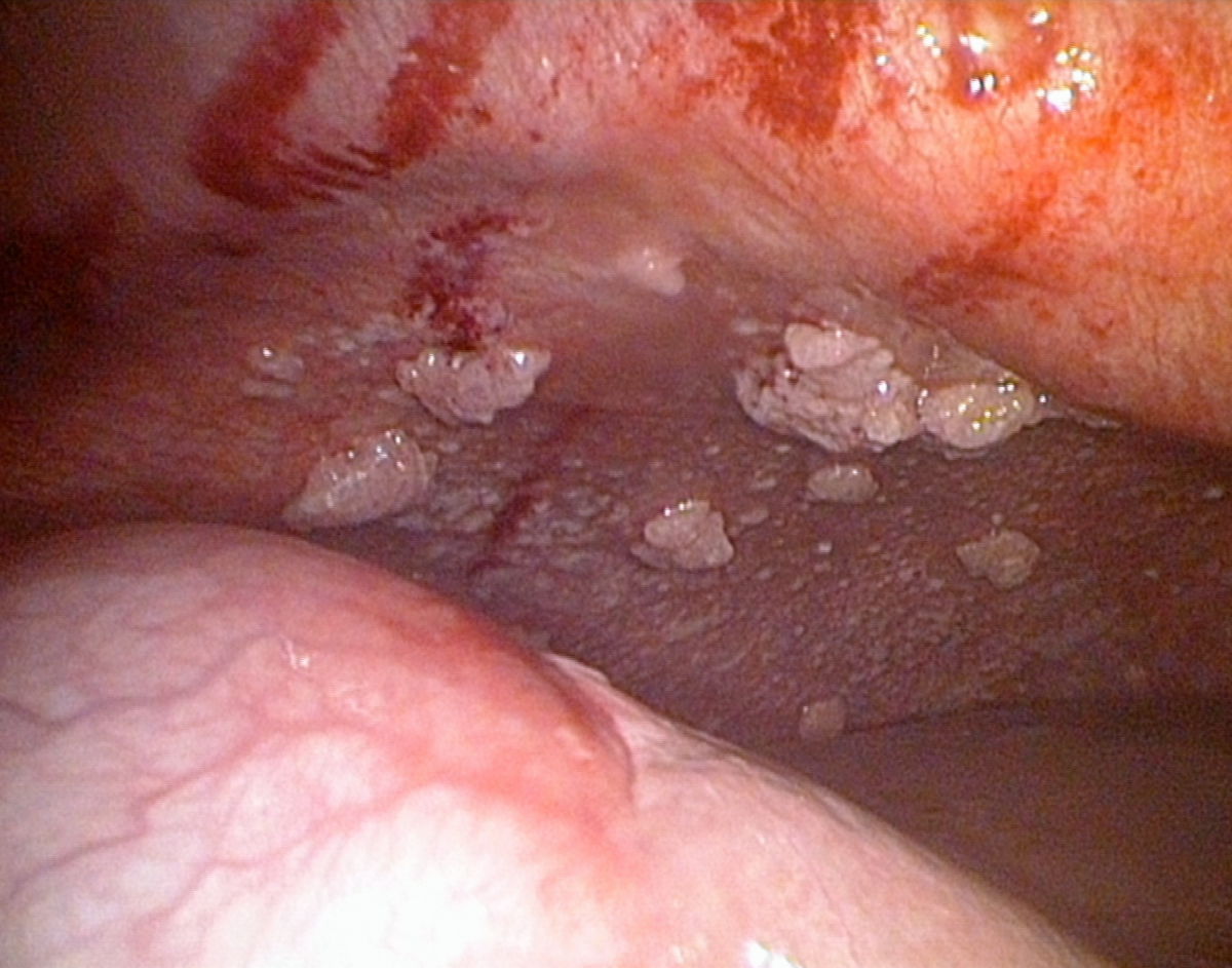 Ovarialcarcinom- Peritonealcarzinose