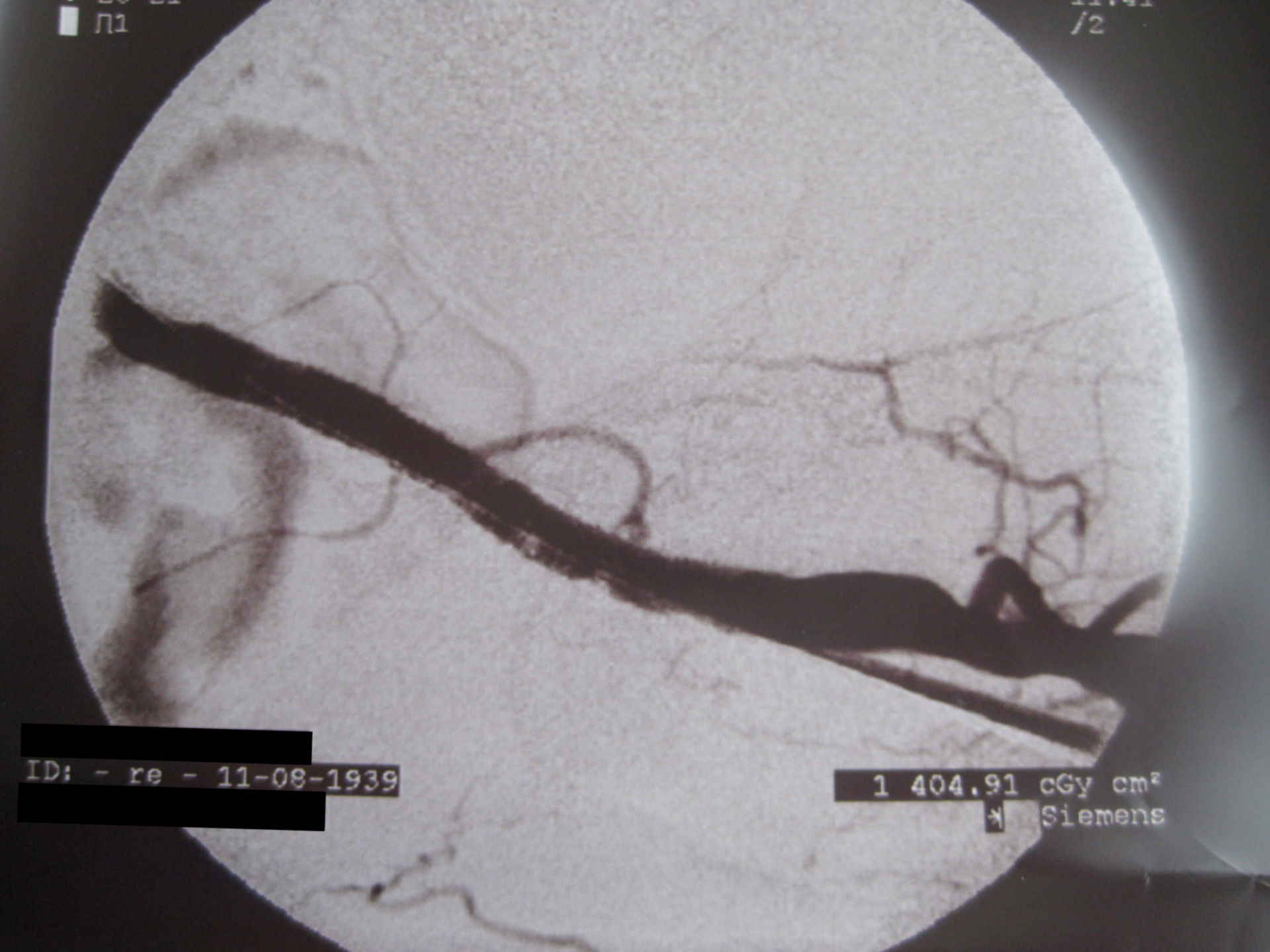 DSA pelvic artery after PTA and stent implantation