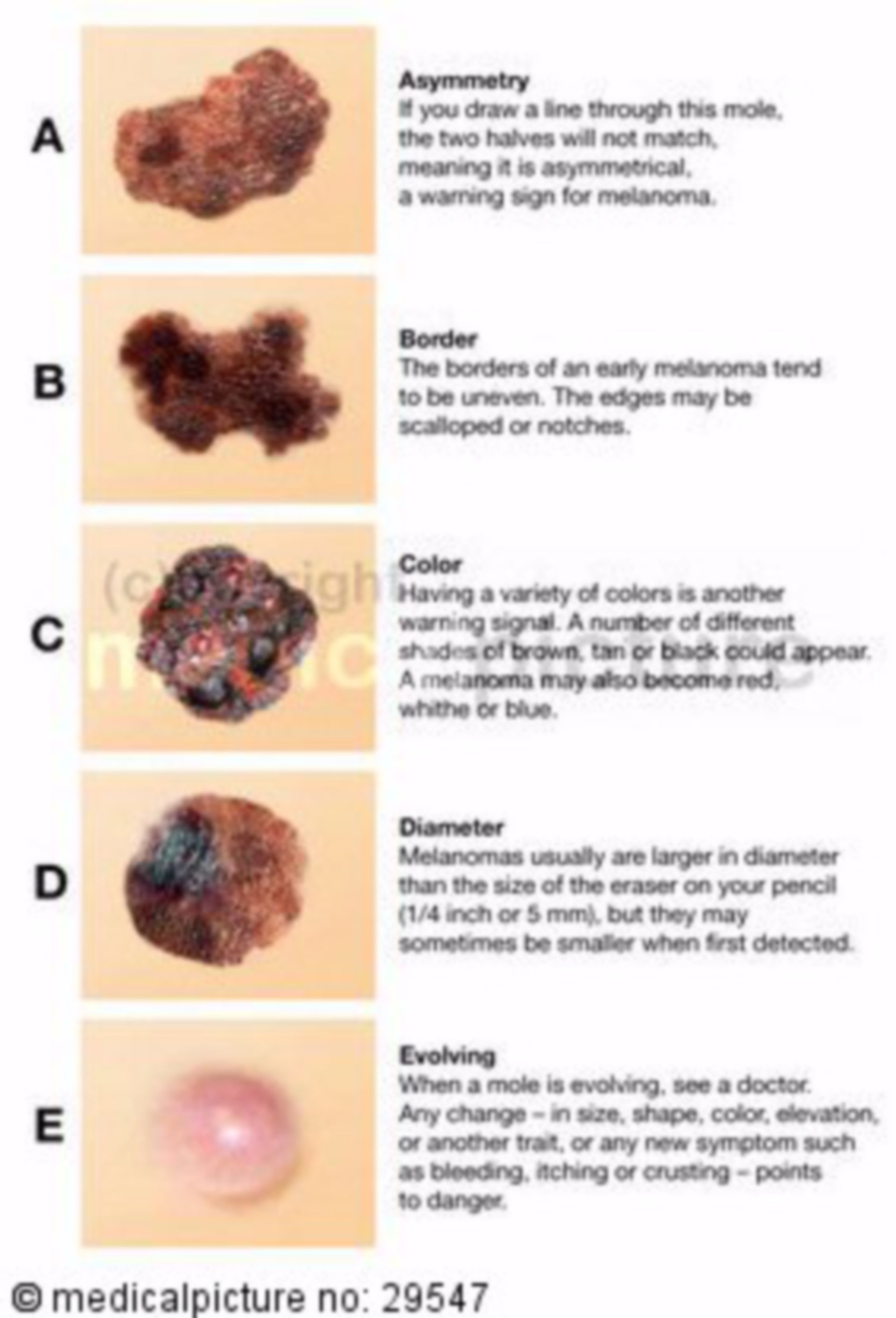 ABCDE-Regel zur Hautkrebs-Erkennung