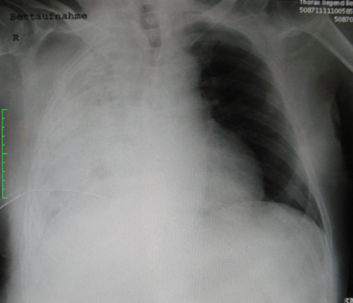 Thoraxdrainage bei Hämatothorax rechts