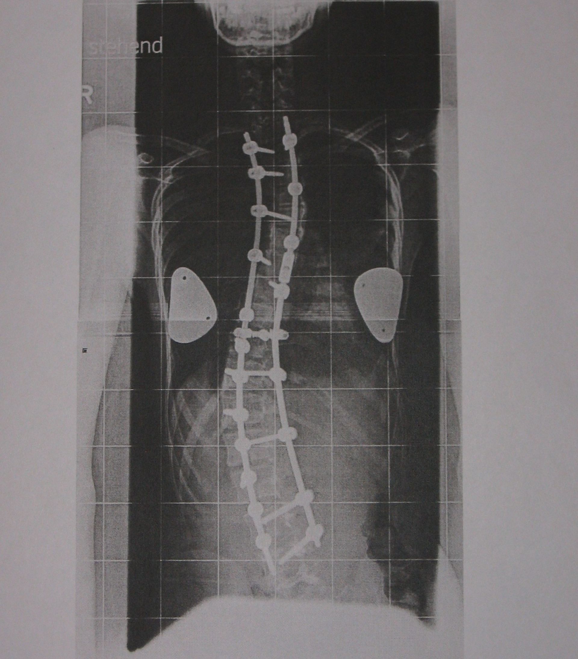 Juvenile scoliosis - postoperative X-ray