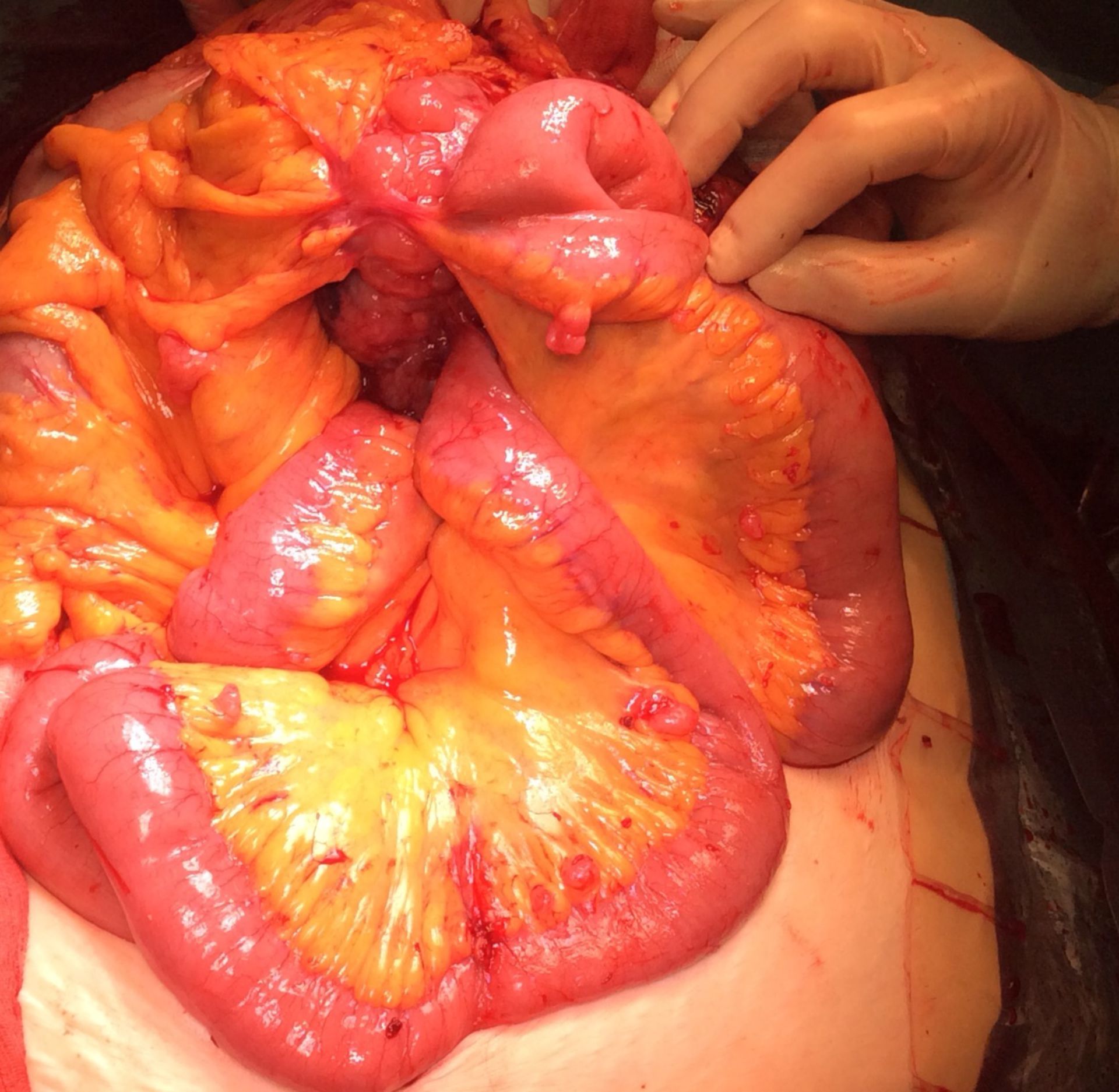 Tumor of the small intestine GIST