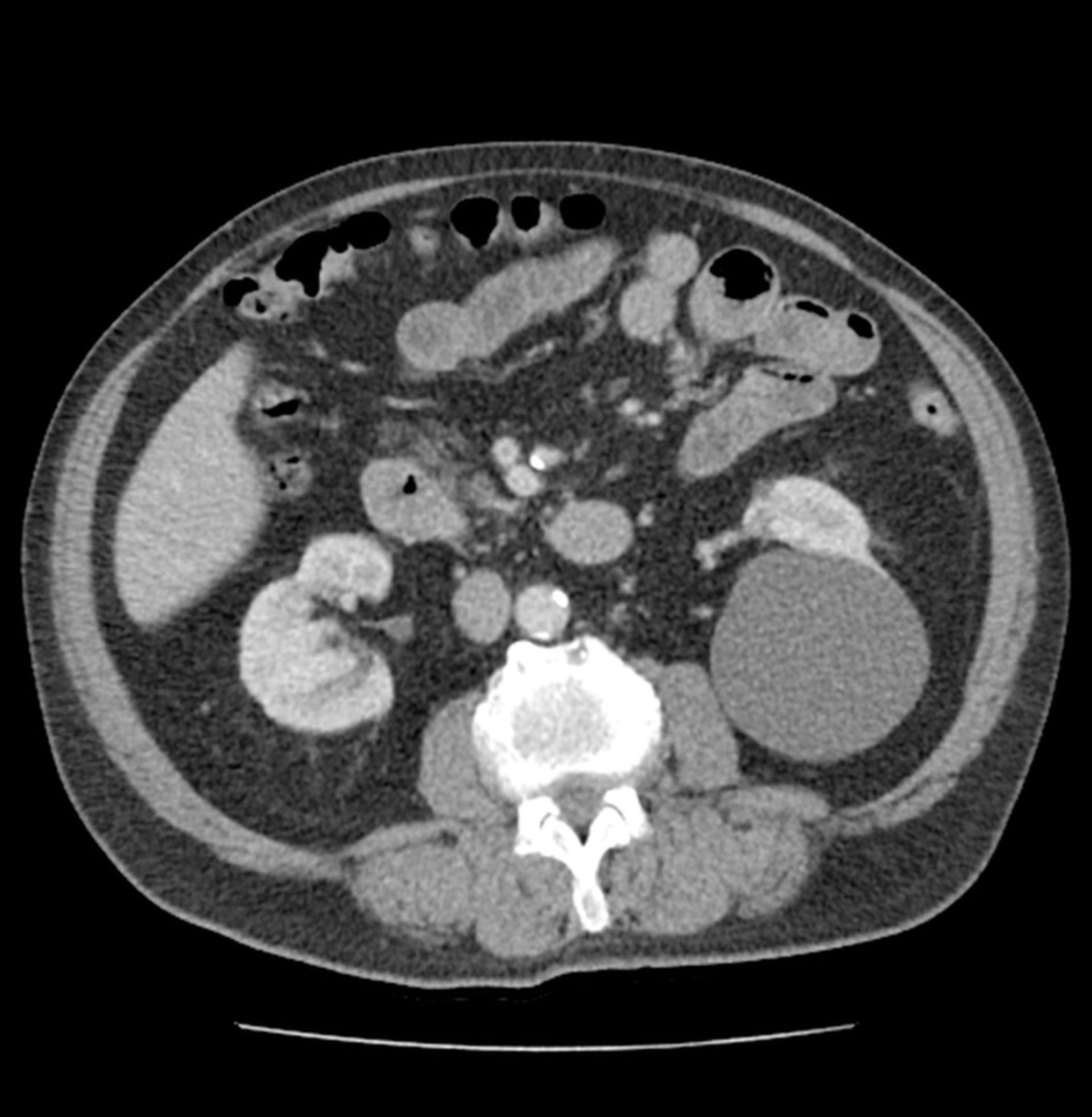 CT des Abdomens in transversaler Ebene mit Nierenzyste links