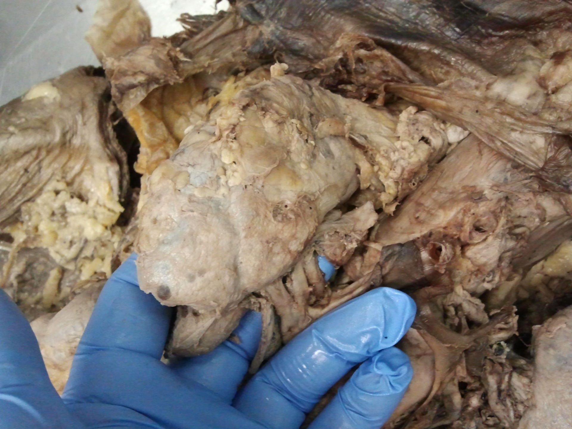 Renal cysts, right kidney, outer side