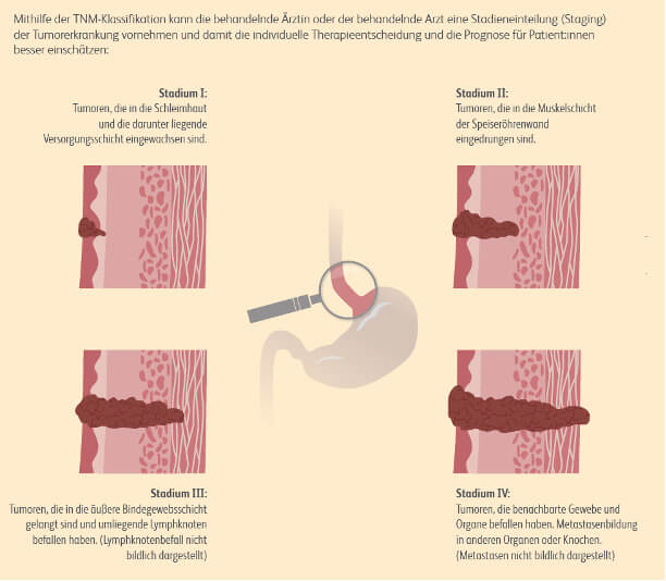 Histologie von Speiseröhrenkrebs