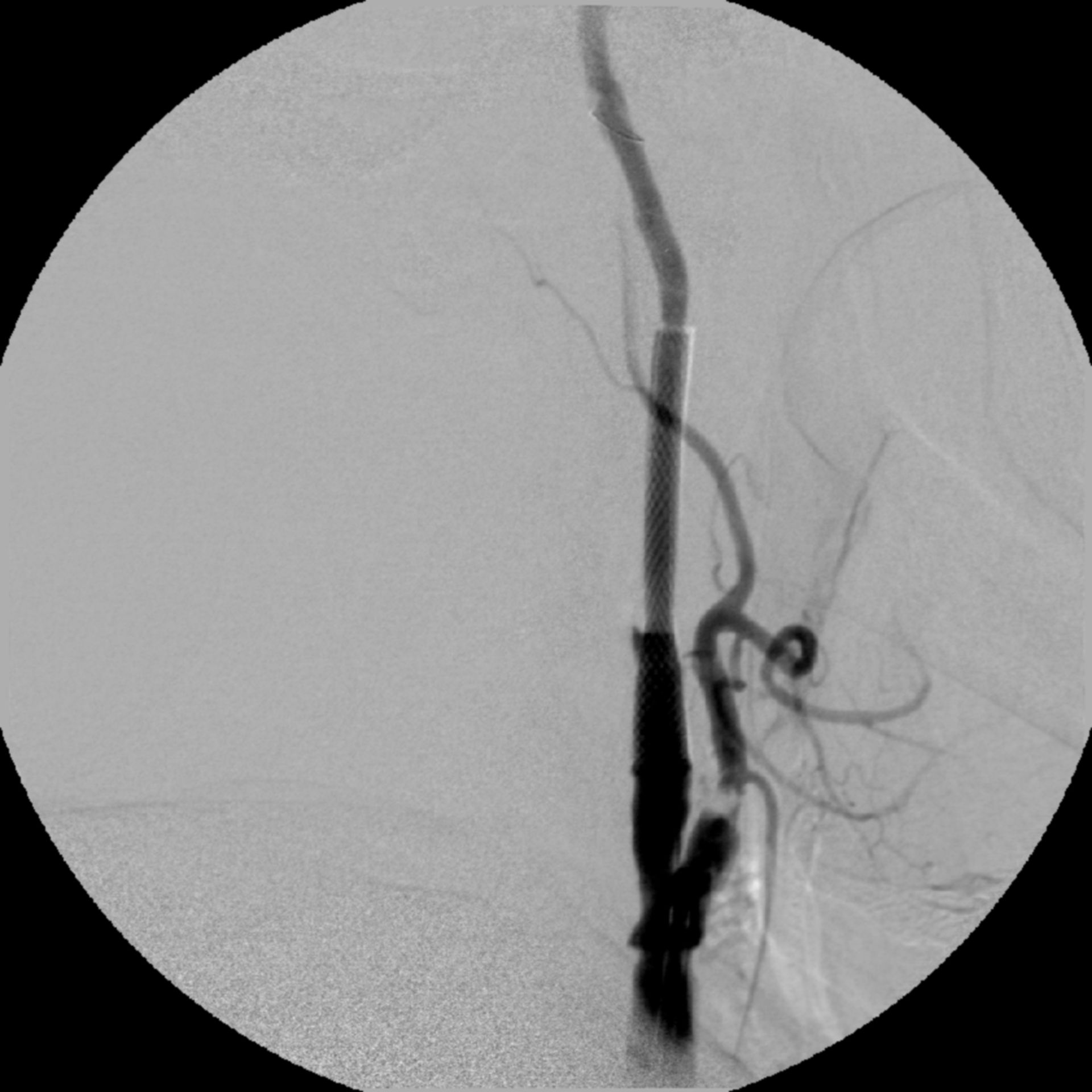 Risultato dopo PTA della carotide e stenting