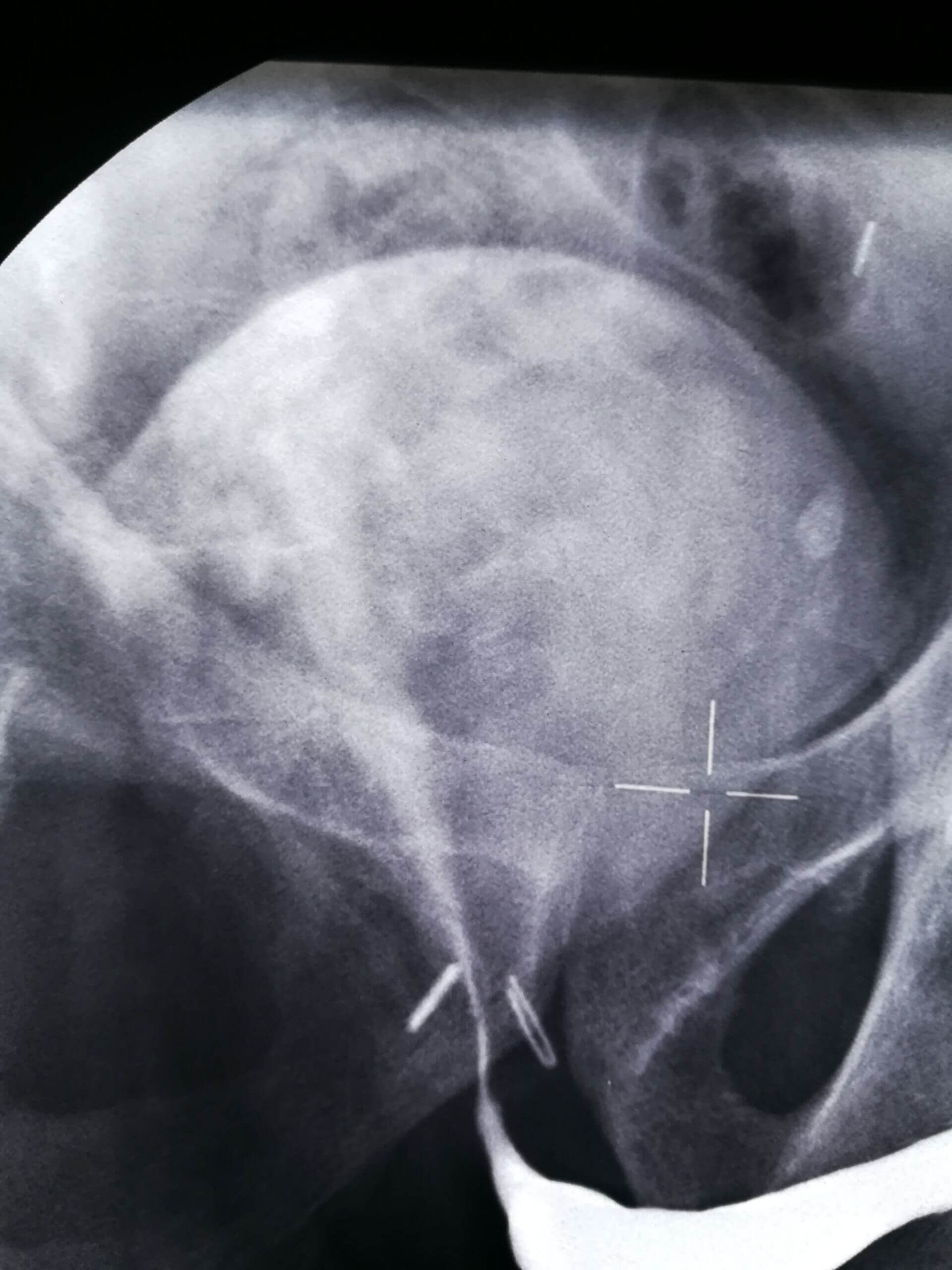 Hochgradige Urethrstenose, Therapie?