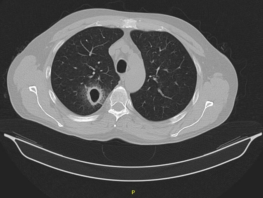 doccheck_-_07_-_komplexe_lungeninfektion_bild3_abszess_original.jpg