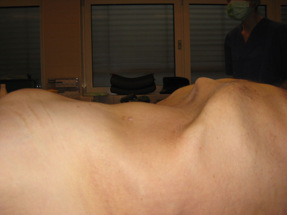 Bauchaortenaneurysma - durch die Bauchdecke erkennbar