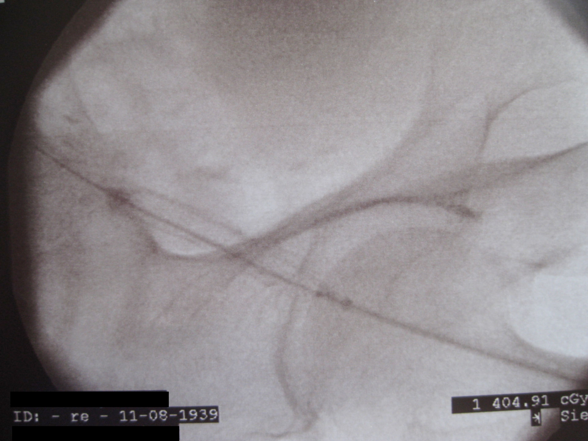 PTA der Beckenarterie mit Stenteinlage 8 mm