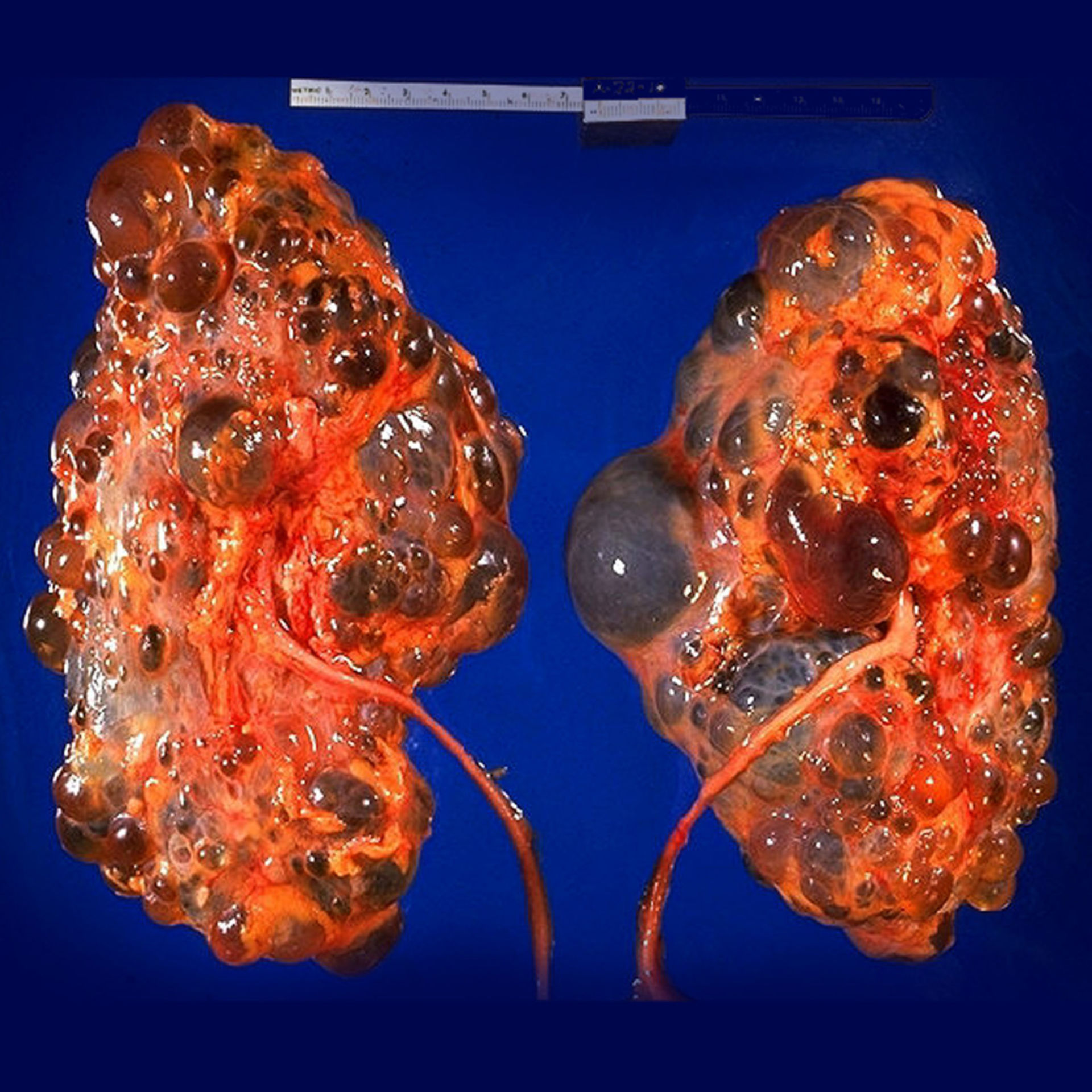 Autosomal dominant polycystic kidney disease