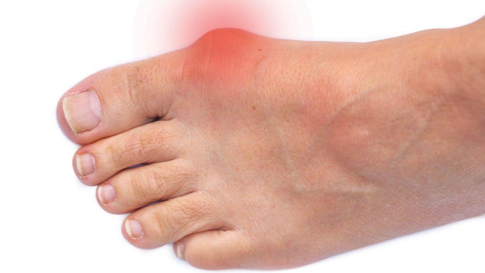 everything_you_should_know_about_bunions_original.jpg