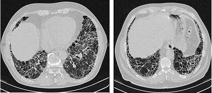 hr_tomography_of_the_chest_of_an_ipf_patient_original.jpg