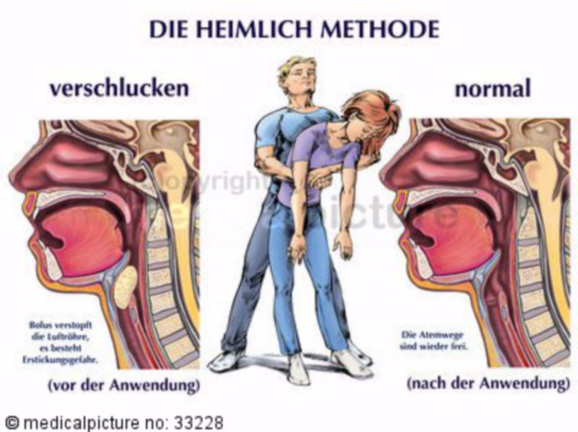 HeimlichHandgriff Illustration DocCheck