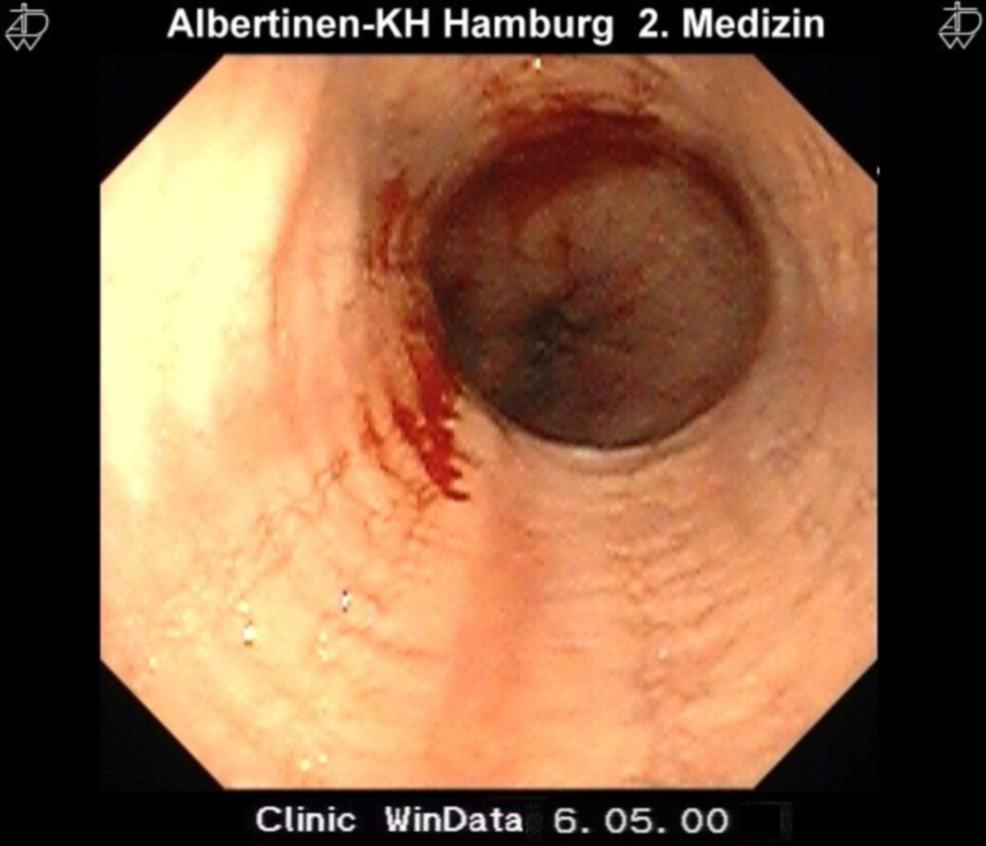 Eosinophile Oesophagitis (3)