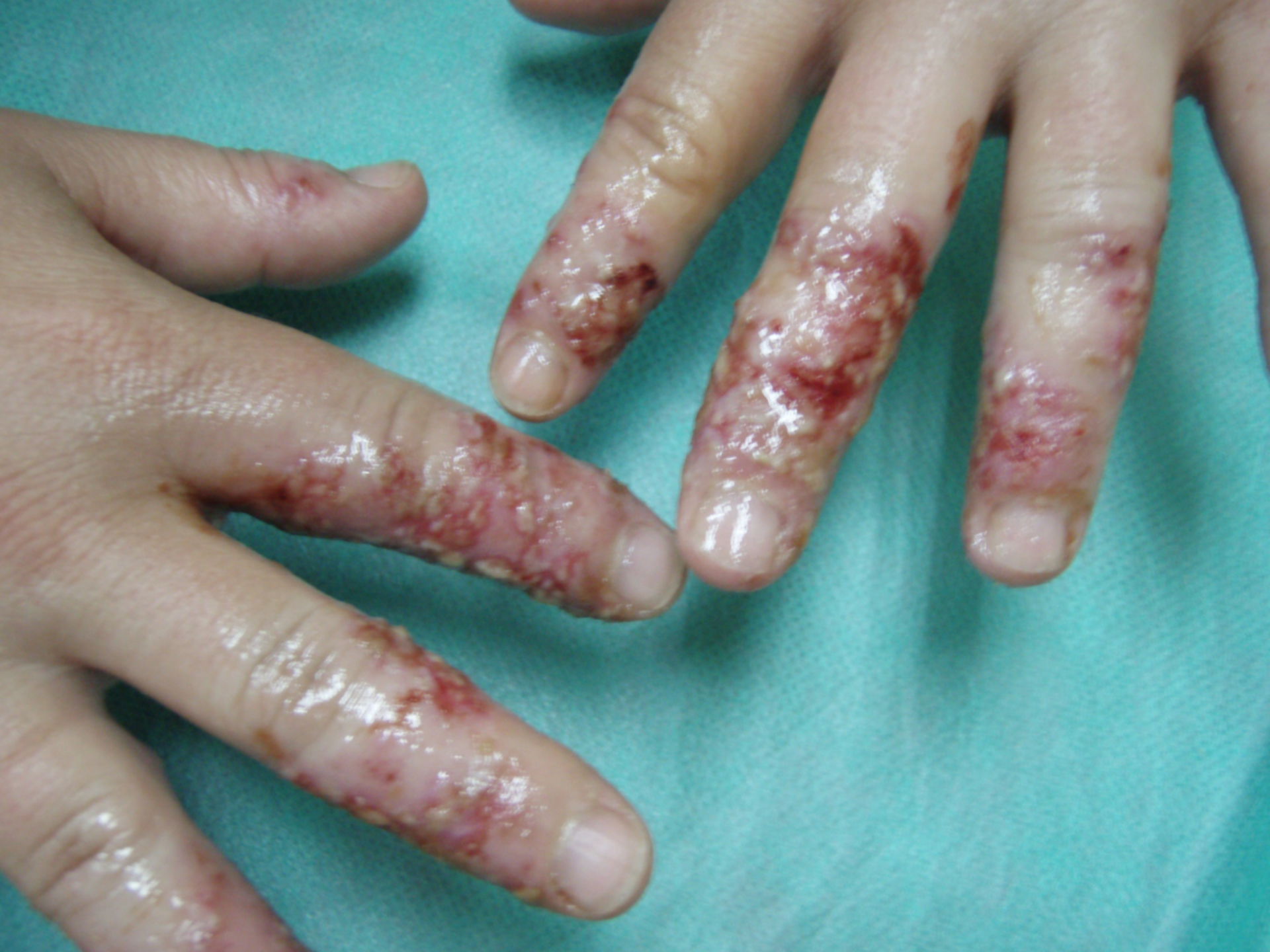 Dermatitis der Finger