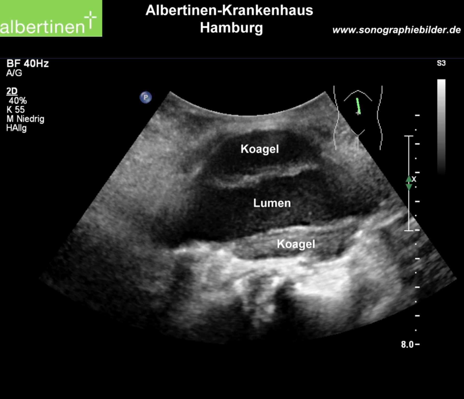 Sonography: Concentric abdominal aortic aneurysm, laterally