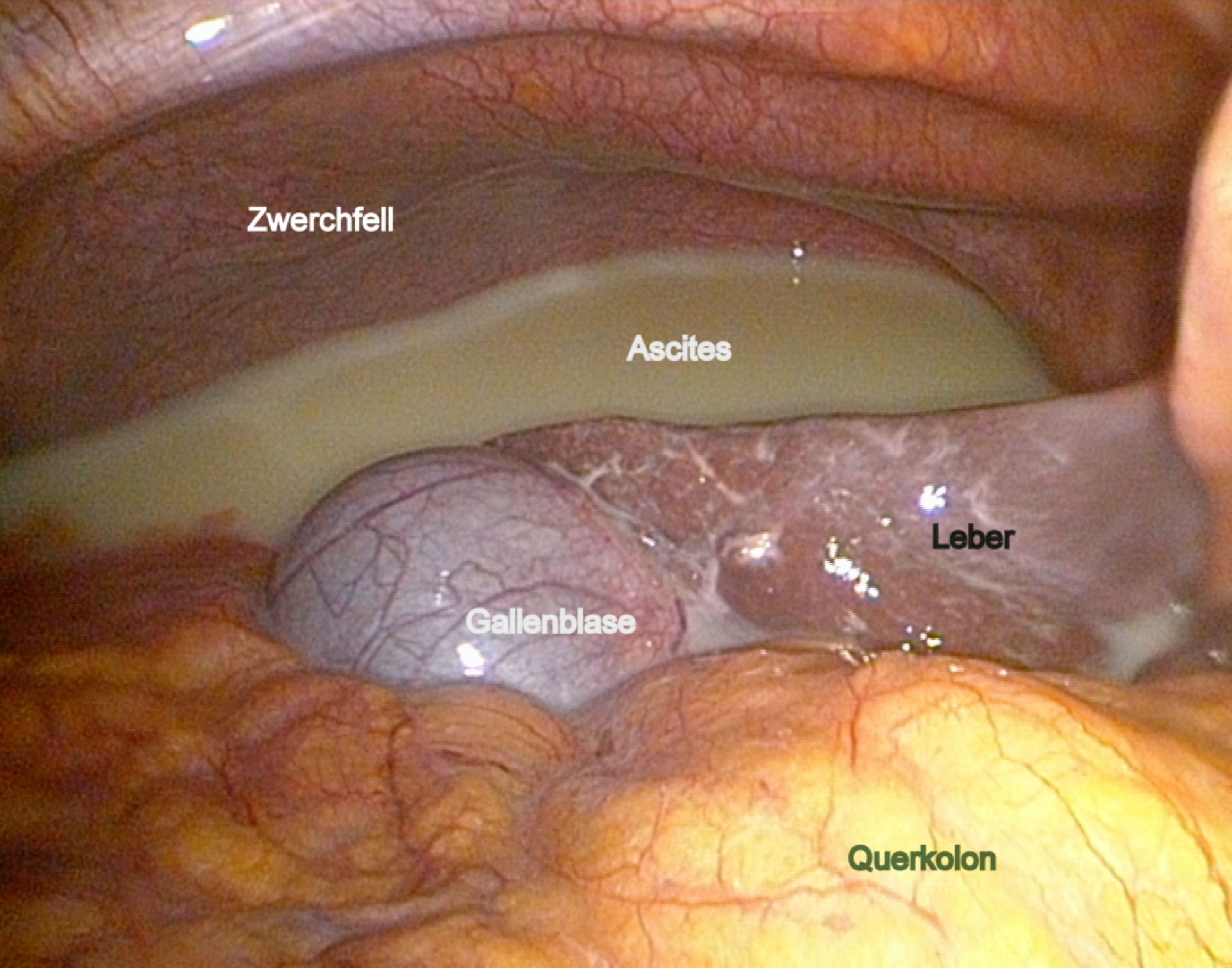 Ascite (contenente chiloso)