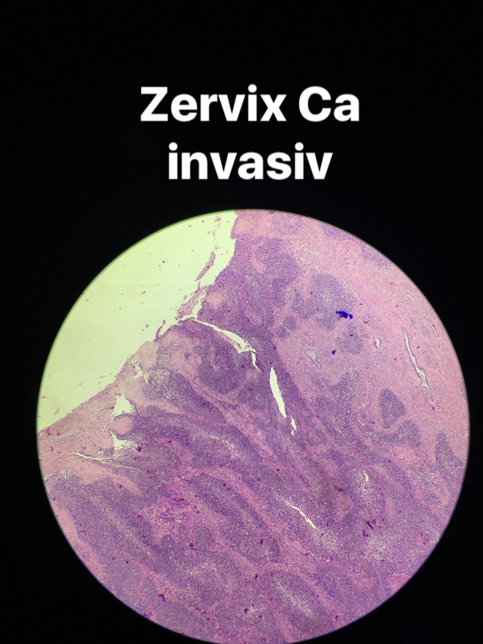 Zervix Cainvasiv