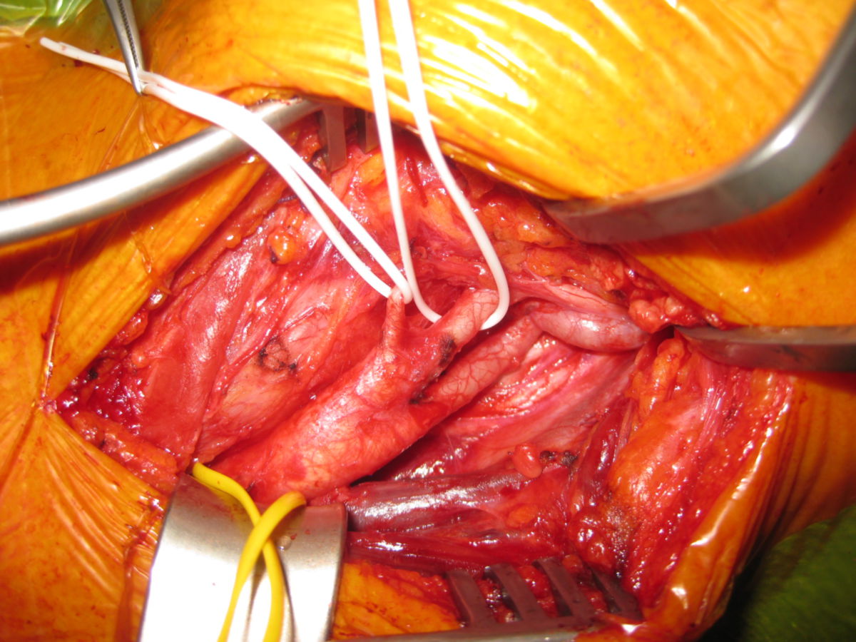 Carotisgabel mit Knick in der Arteria Carotis Interna