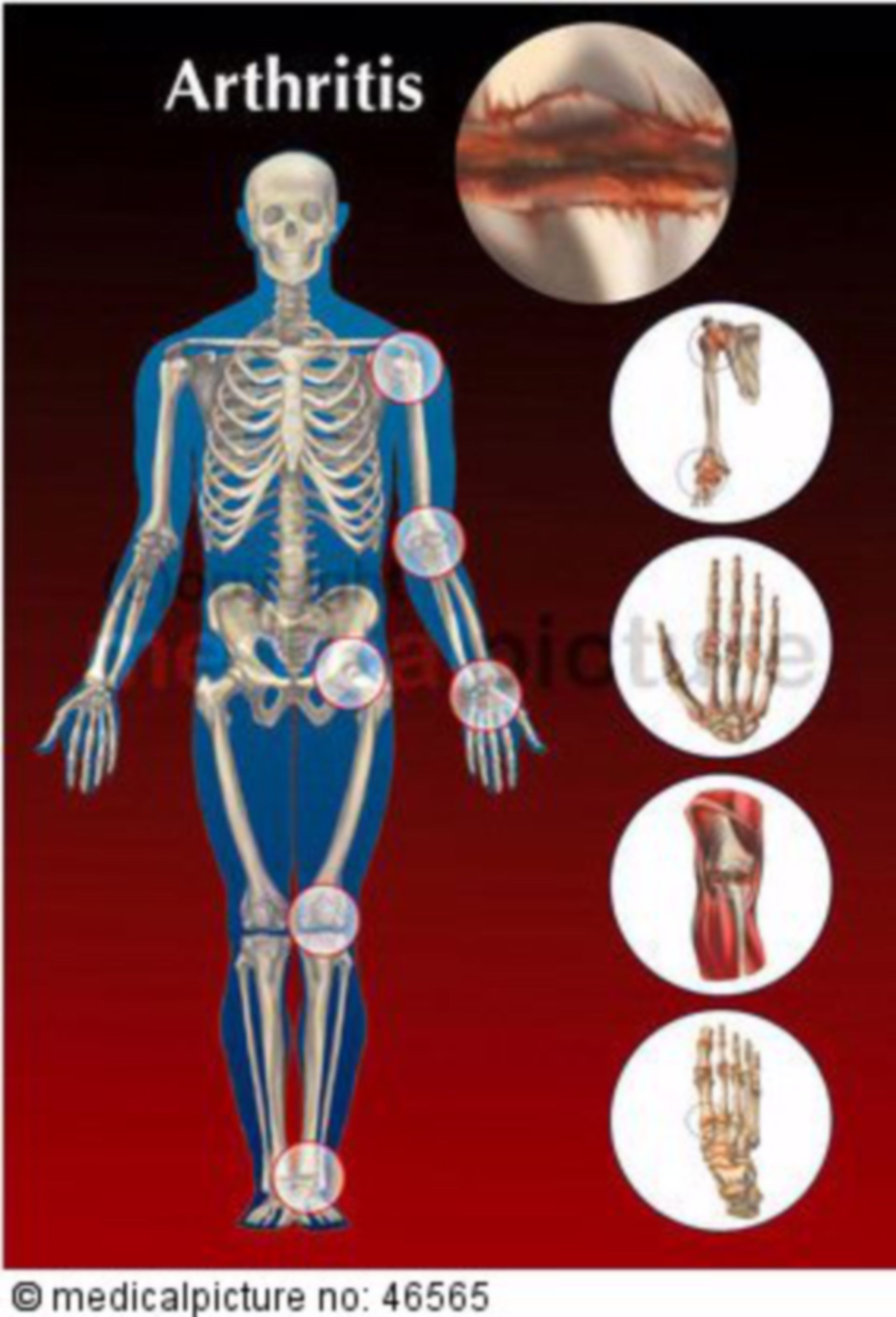  Menschliches Skelett mit Arthritis 
