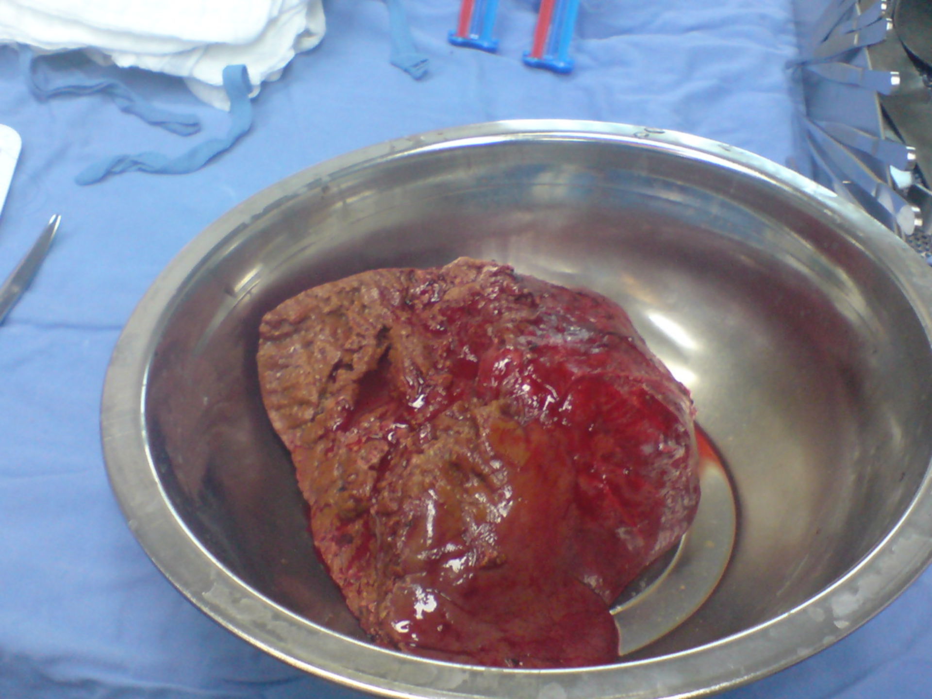 Emangioma epatico dopo emipatectomia sulla destra