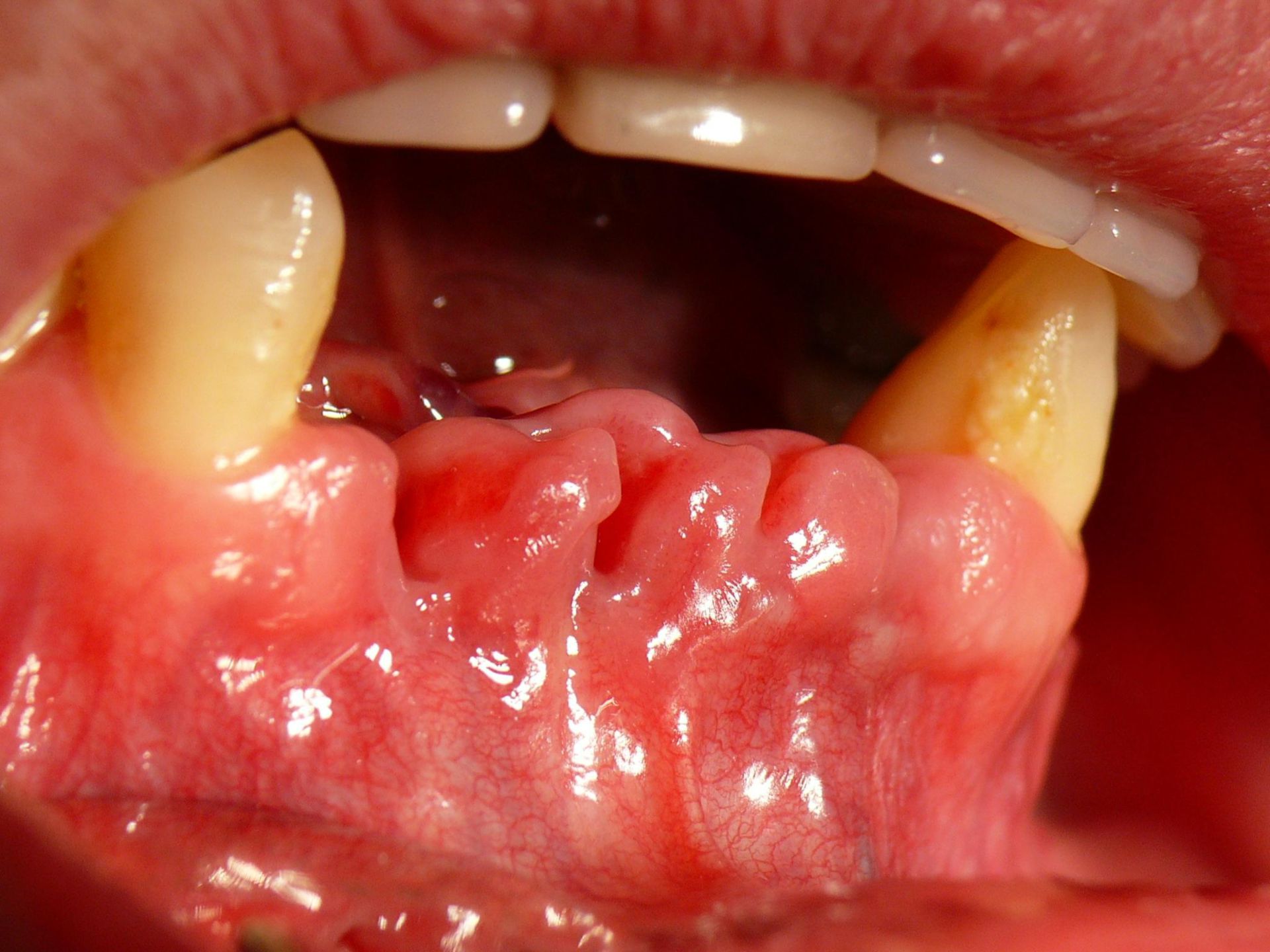 Mandibola inferiore dopo estrazione dentale