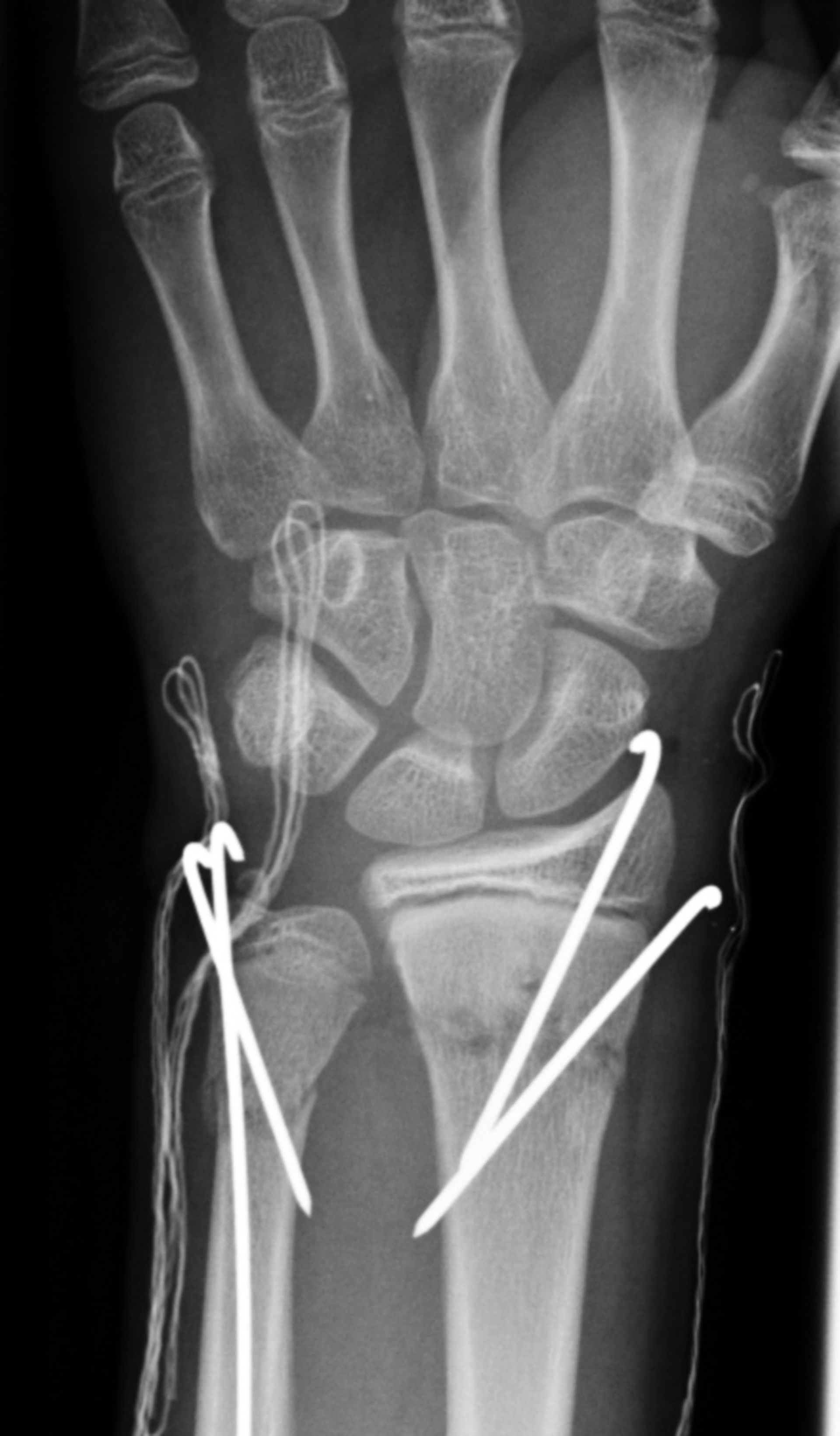 Forearm fracture in a child - Osteosynthesis