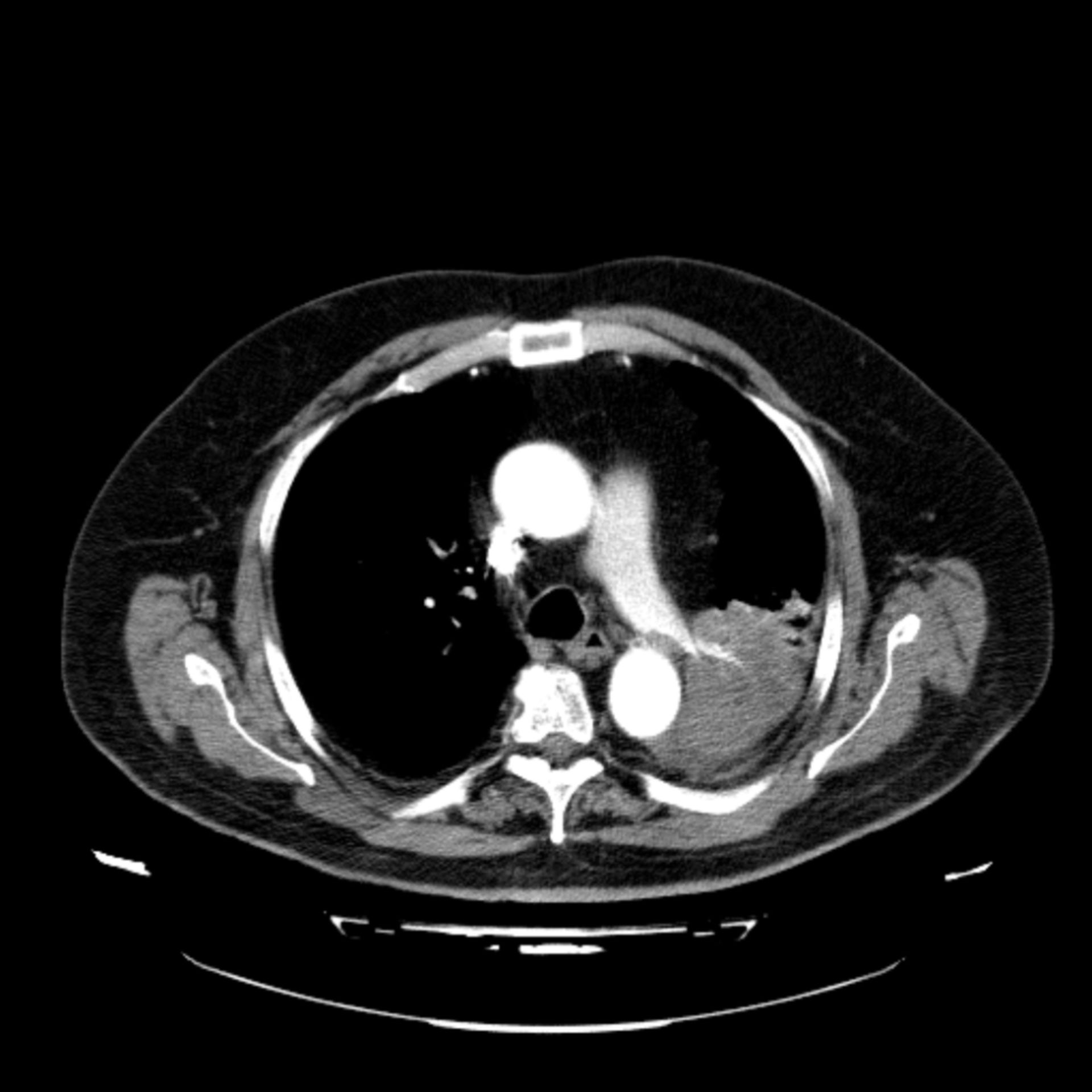 ct_3: CT der Lunge