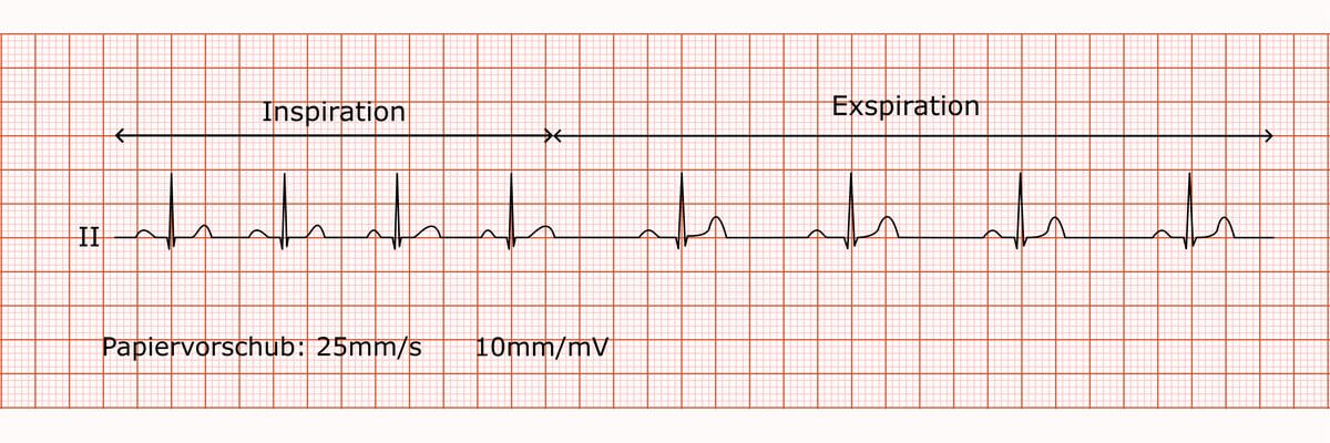 Annotierter Rhythmusstreifen bei respiratorischer Sinusarrhythmie