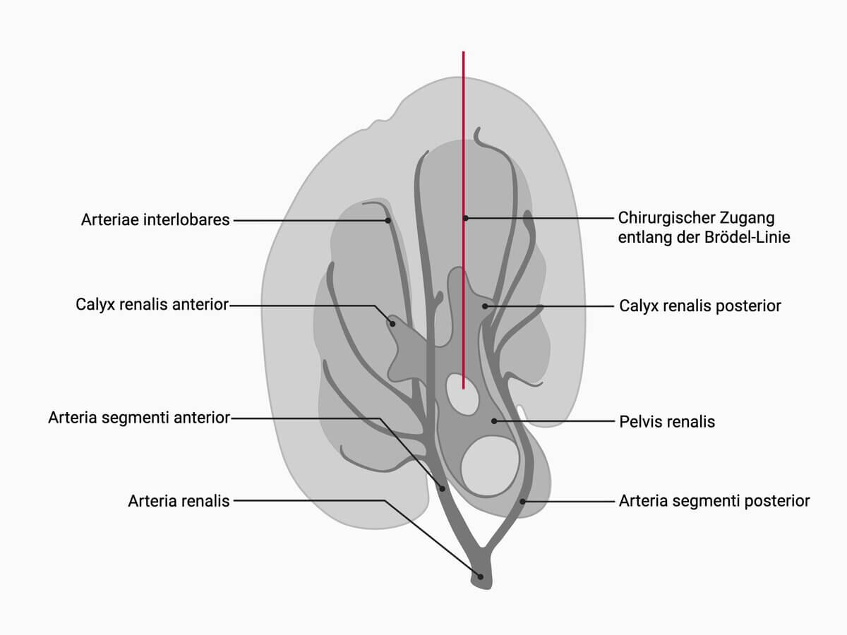 Chirurgischer Zugang entlang der Brödellinie