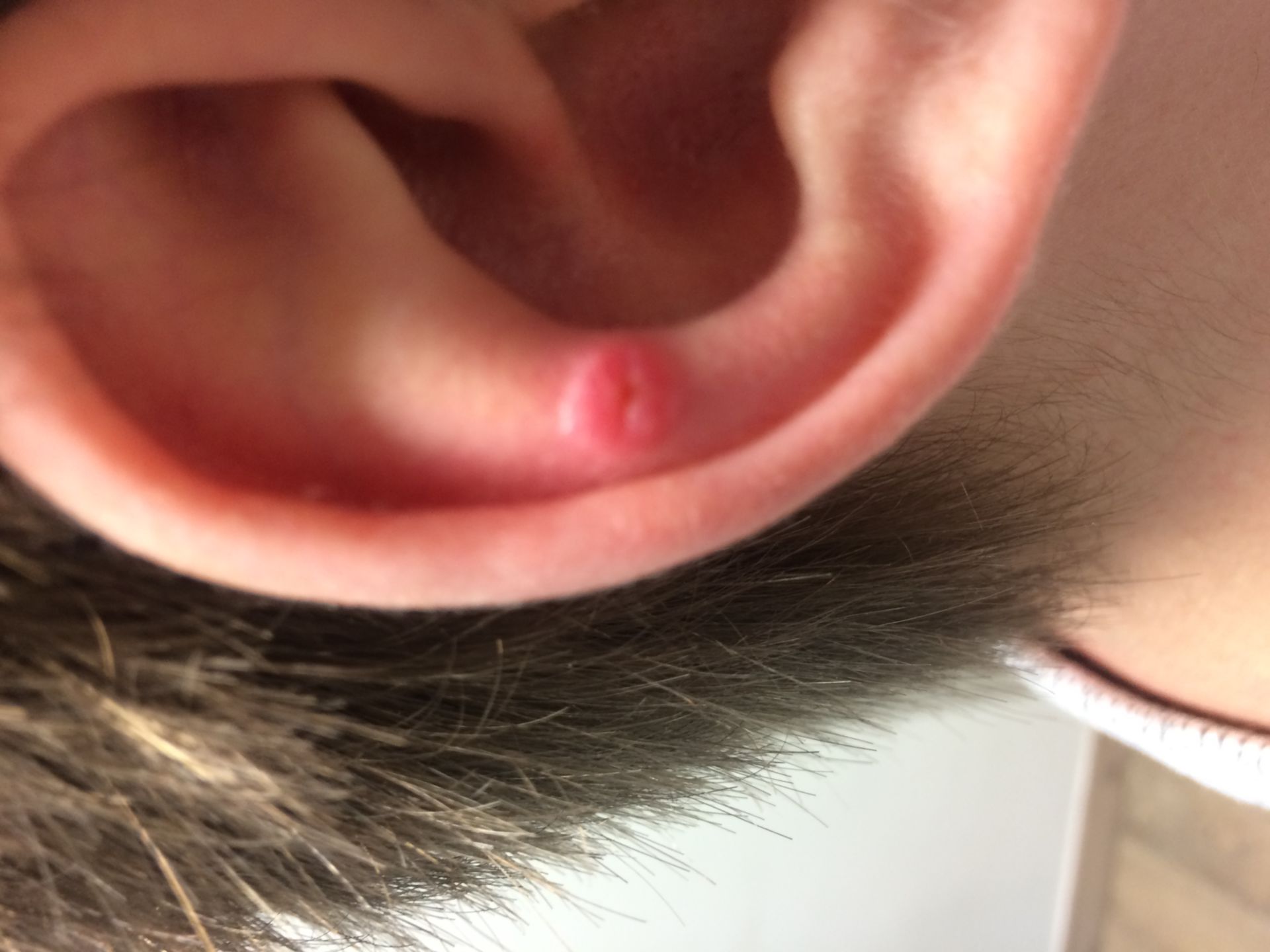 Druckstelle durch On-ear-Kopfhörer