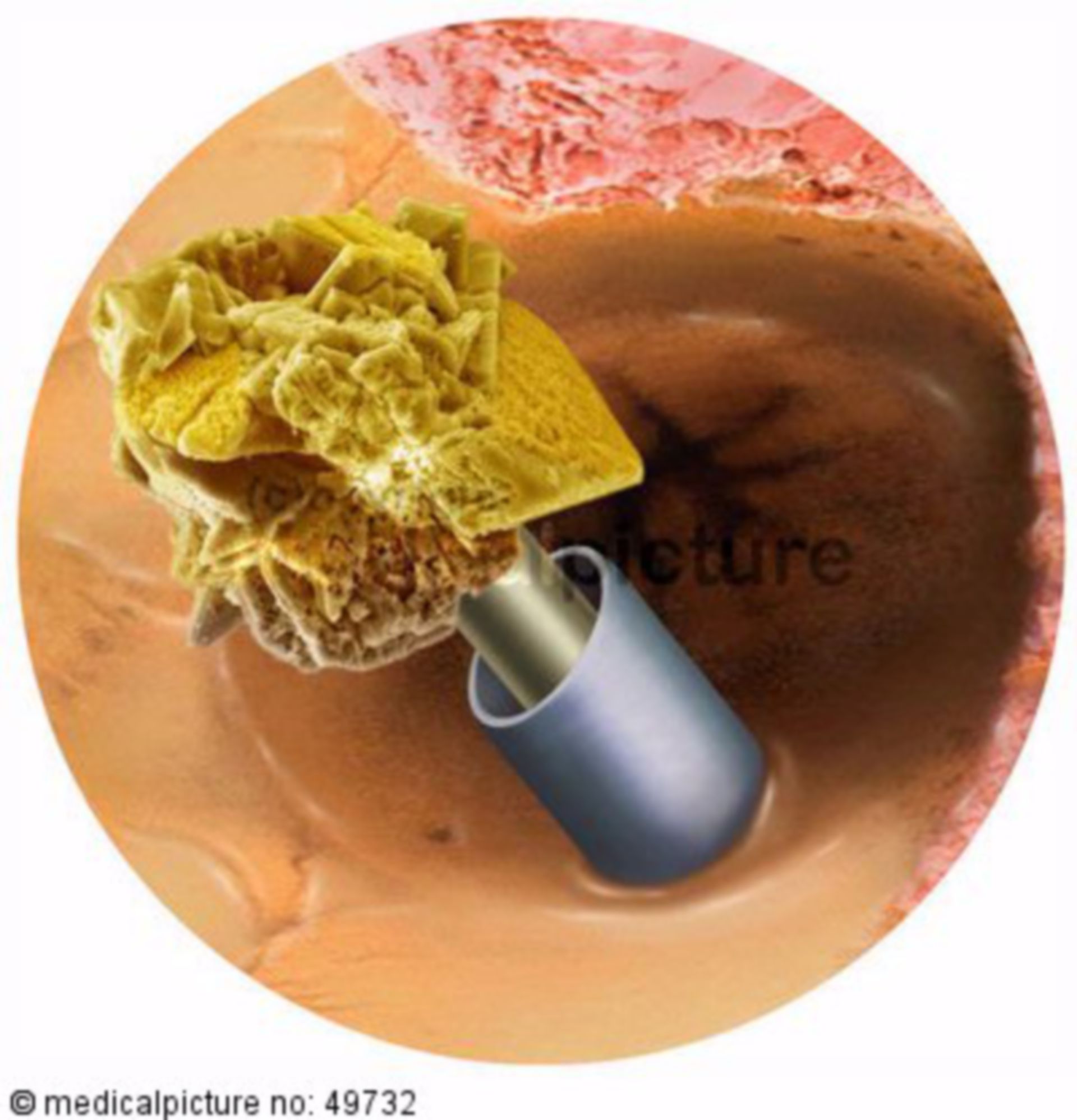 Kidney stone destruction in case of nephrolithiasis, renal pelvis