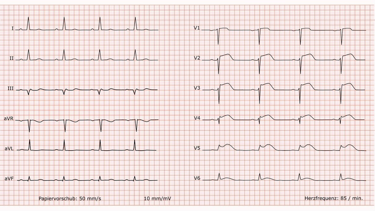 12-Kanal-EKG bei Vorderwandinfarkt