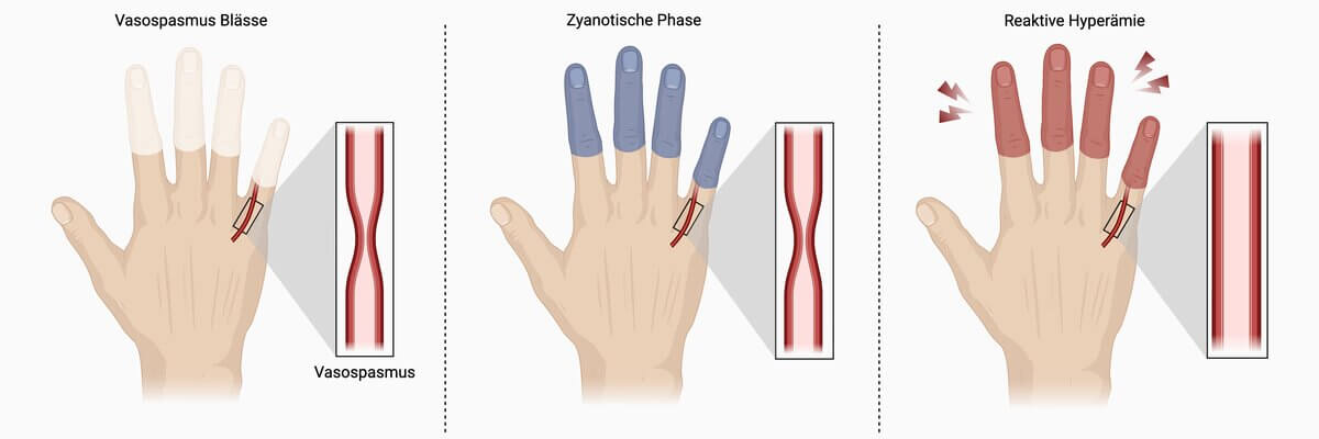 Raynaud-Syndrom Phasen