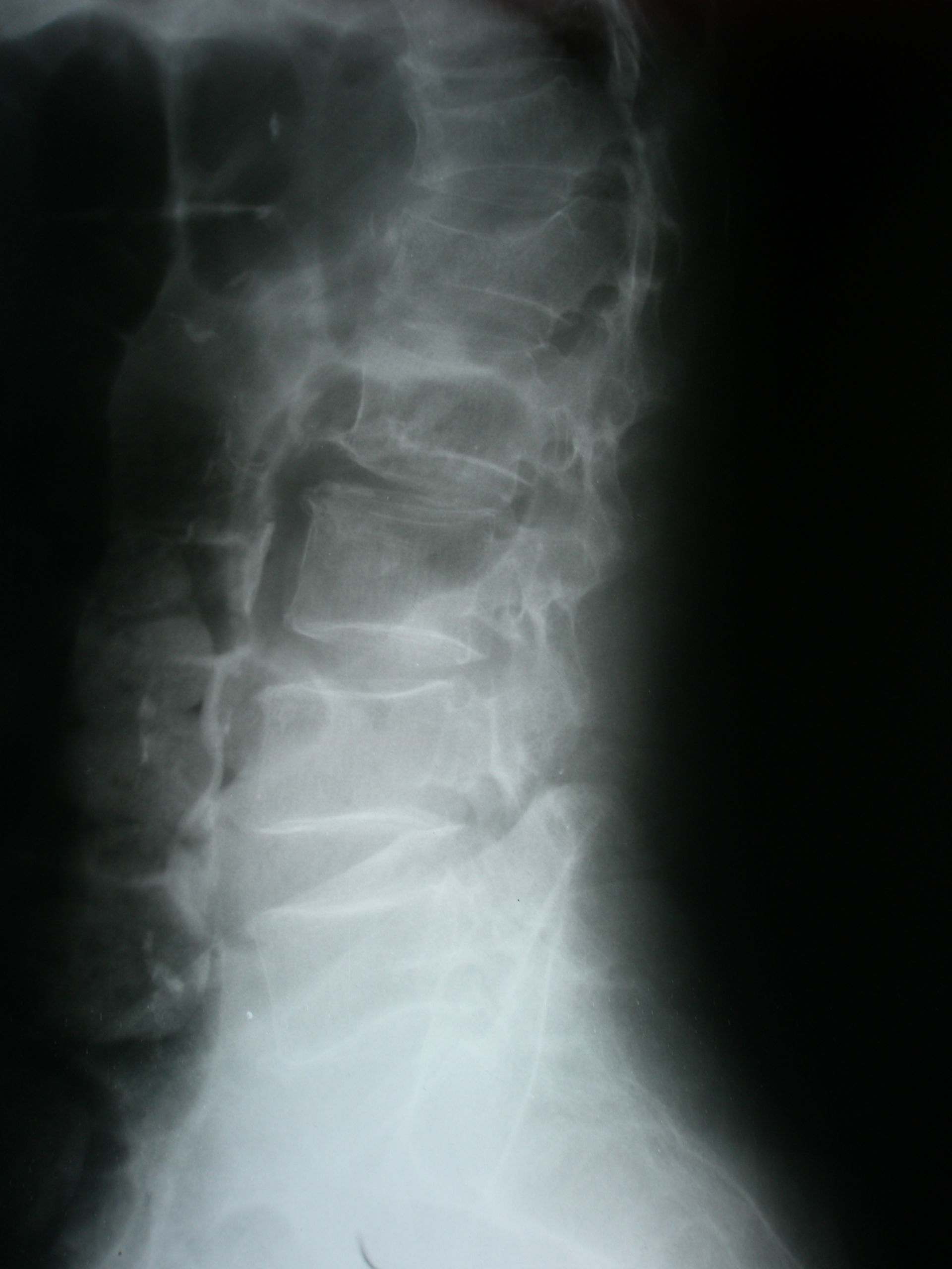 Frattura vertebrale