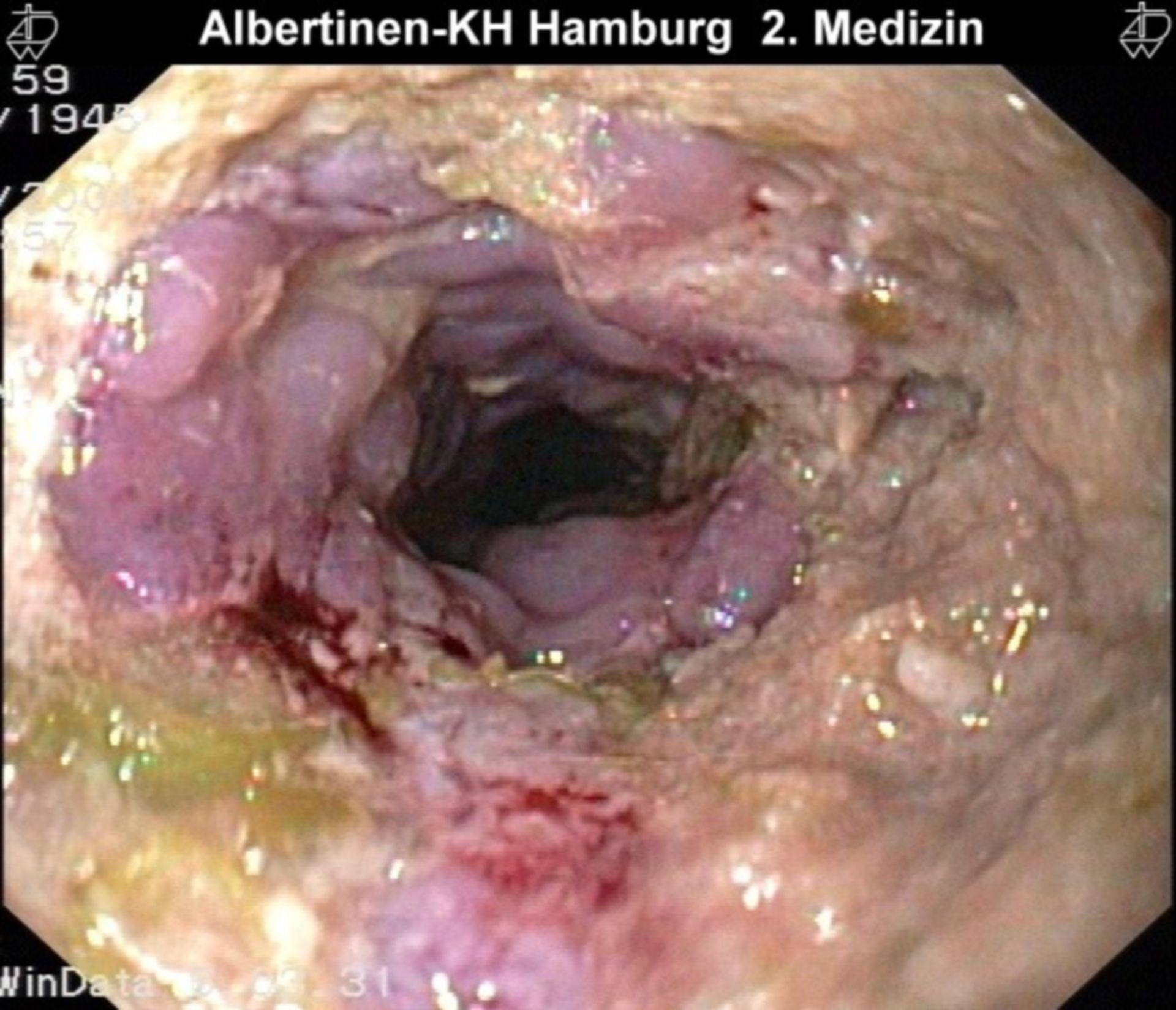 Bolus Overgrowth