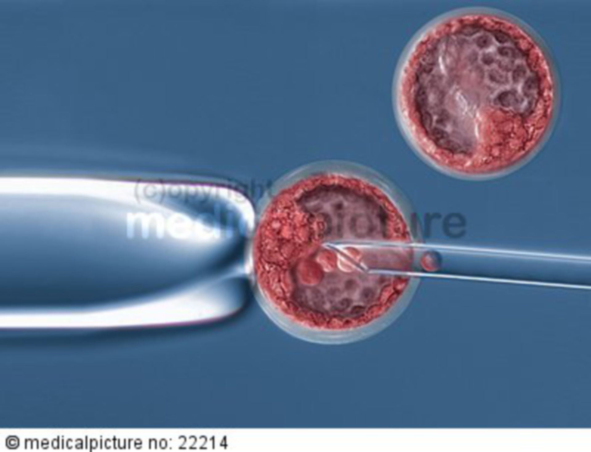 Entnahme von Stammzellen aus einer Blastozyste