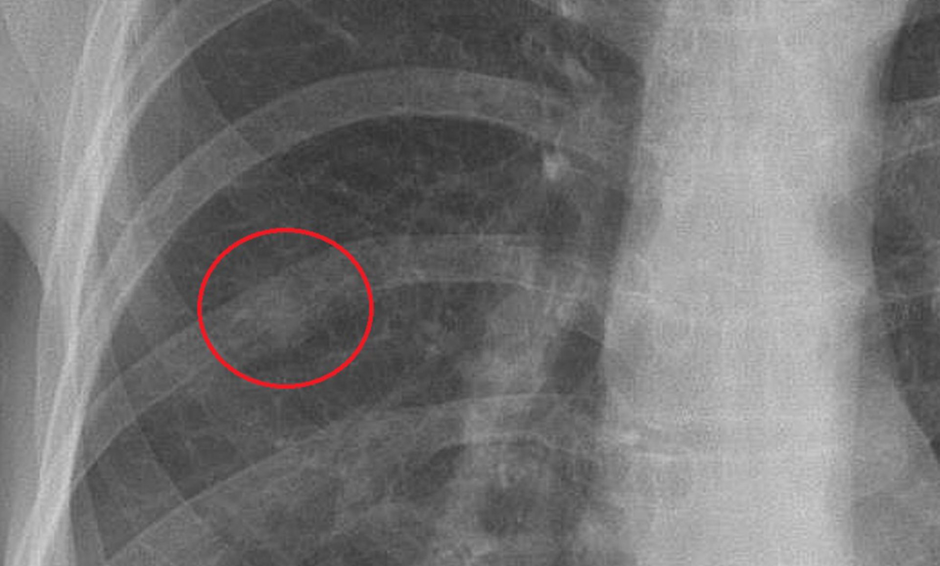 th_pa_ausschnitt1: Röntgen des Thorax in frontaler Ebene