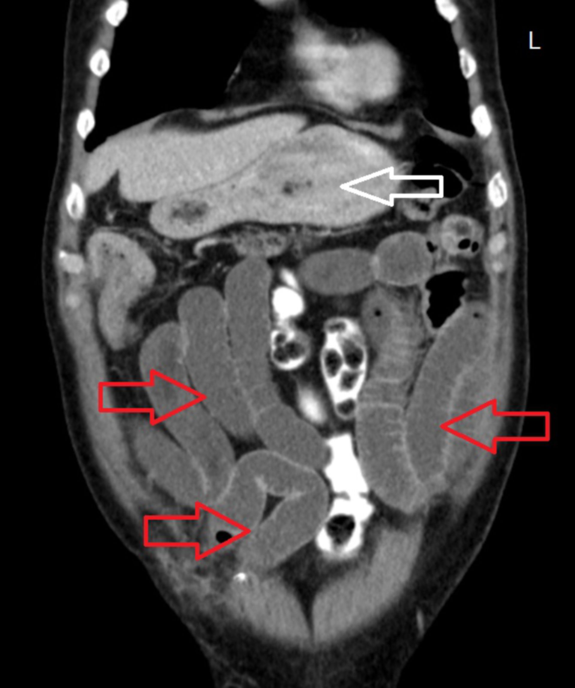 cor1: CT des Abdomens