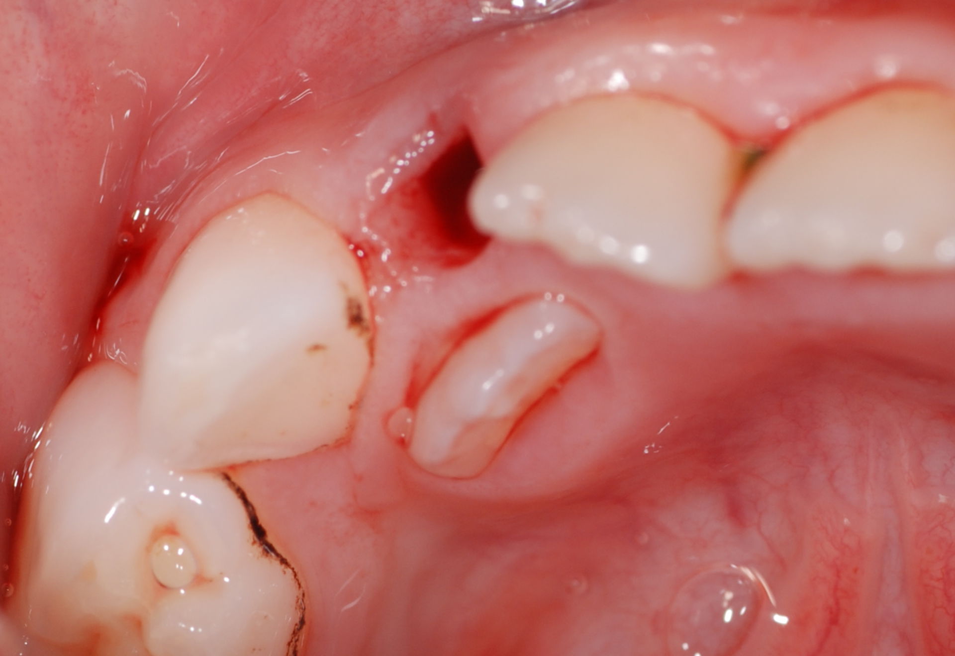 After the extraction of the deciduous tooth