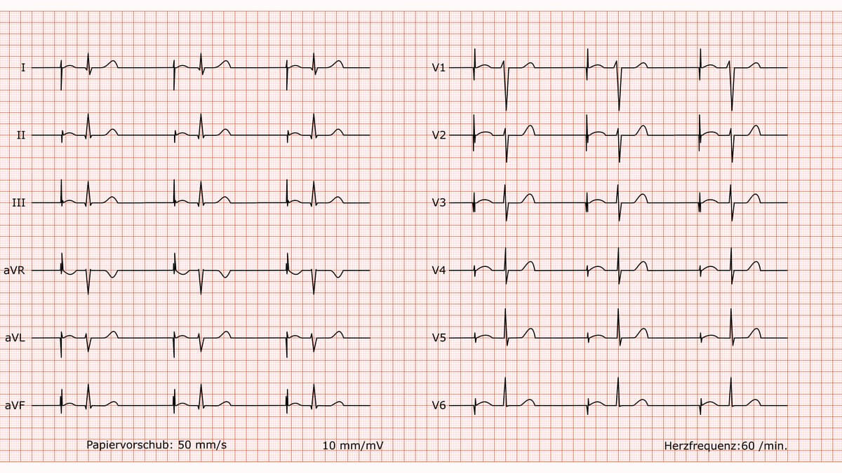 12-Kanal-EKG bei AAI-Schrittmacher