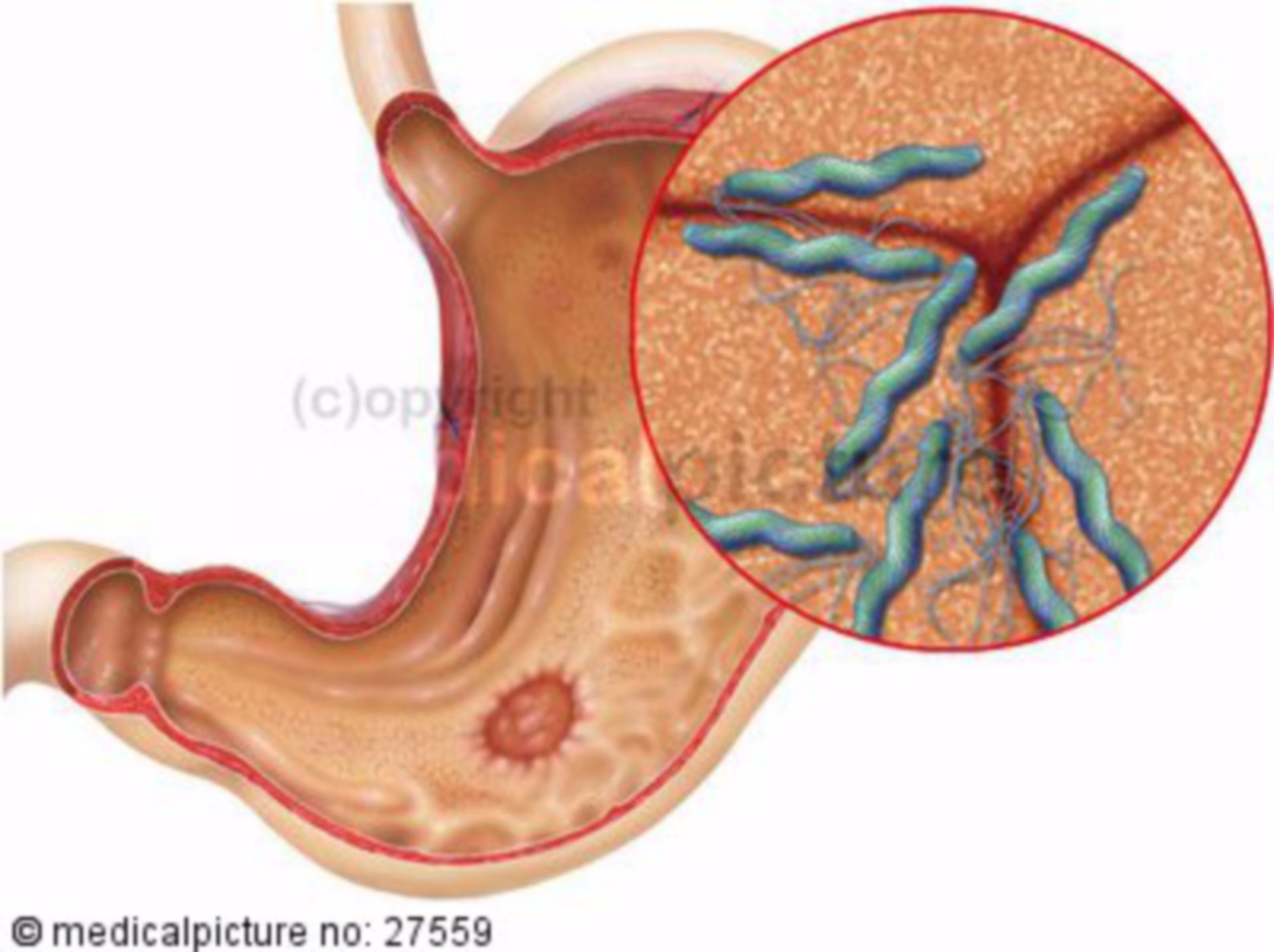 Helicobacter Pylori and Gastric Ulcer