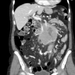 Non-Hodgkin-Lymphom - DocCheck Flexikon