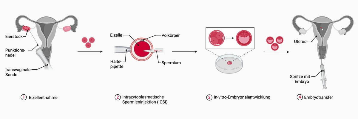 Ablauf Intrazytoplasmatische Spermieninjektion