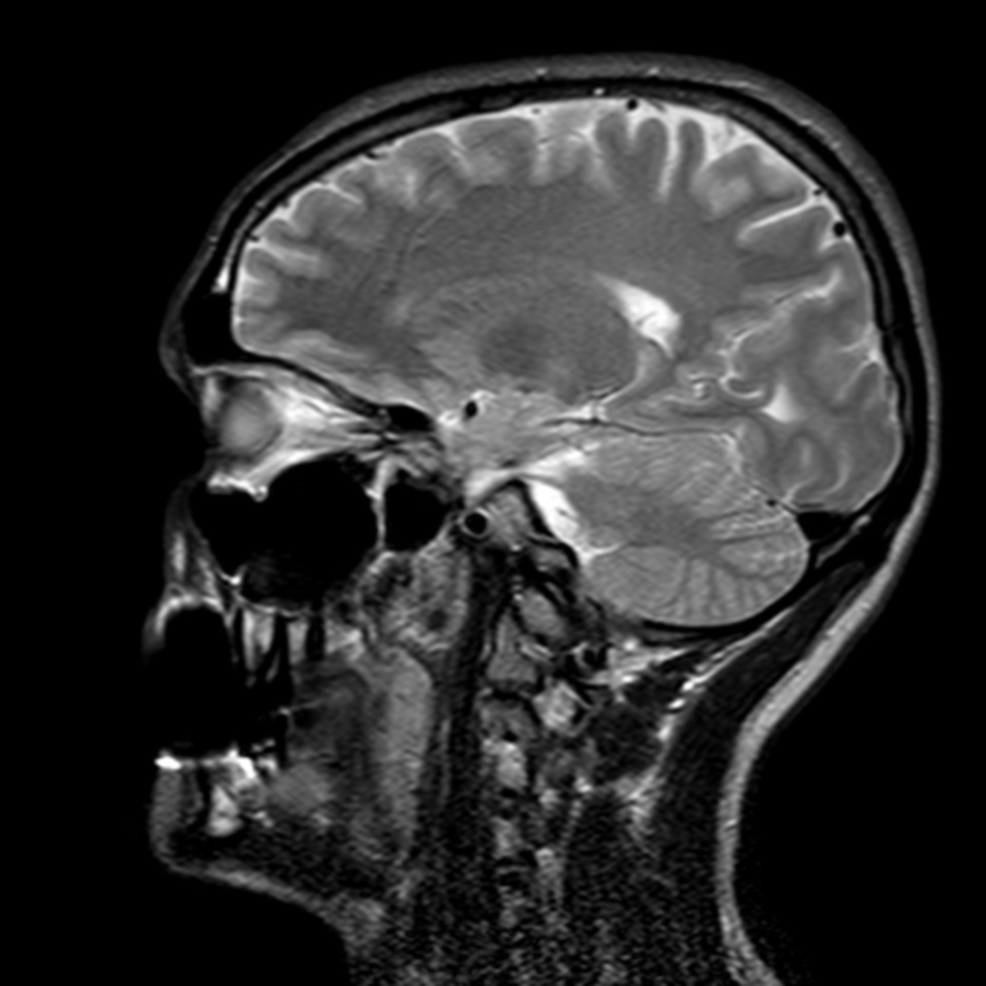 (21/34) MRT Schädel in Sagittalebene, T₂‐gewichtet