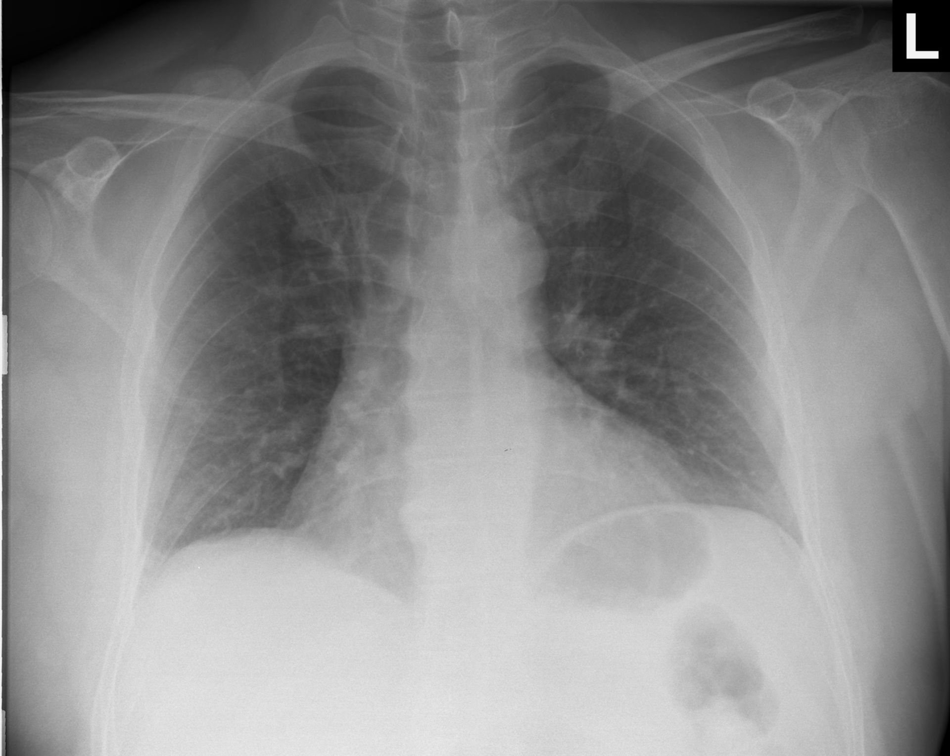 X-ray of the thorax: unclear finding