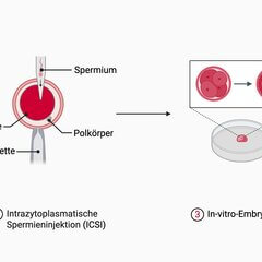 Intrazytoplasmatische Spermieninjektion - DocCheck Flexikon
